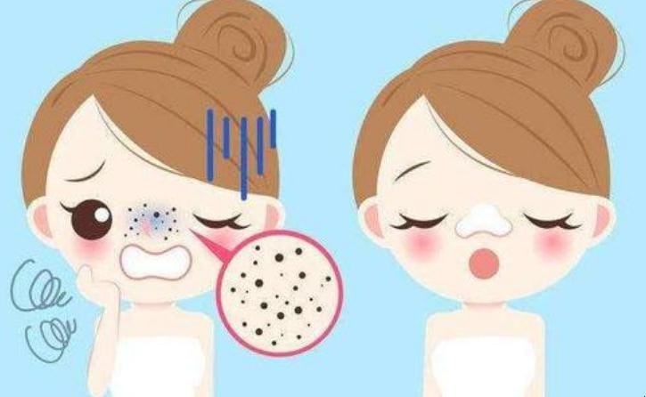 用什么可以有效去黑头 用什么能有效去黑头(图1) 用什么可以有效去黑头 用什么能有效去黑头(图1)