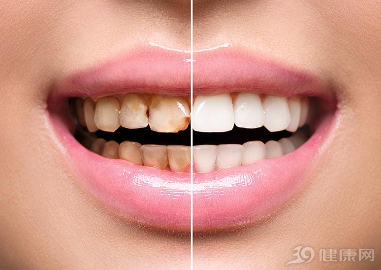 牙齿黄快速美白 牙齿黄怎么美白牙齿(图2)