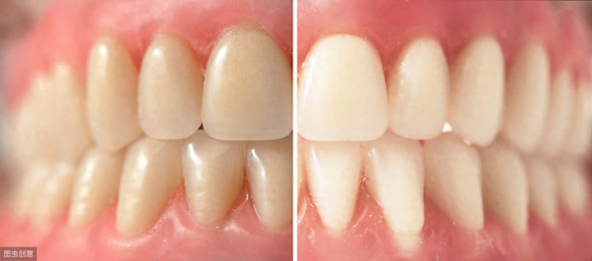 牙齿贴片可以美白牙齿吗 什么是牙齿贴片儿美白(图1)